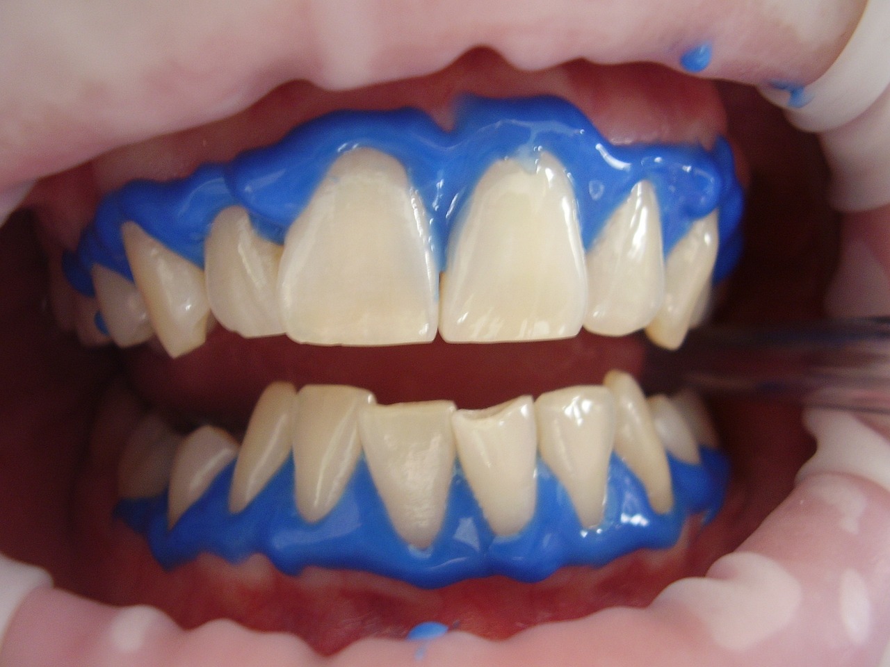 ¿Cuánto se cobra por un blanqueamiento de dientes?