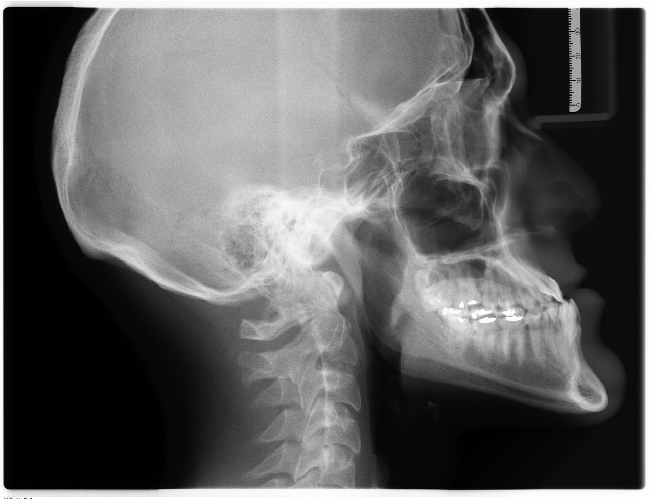 ¿Que se puede detectar en una radiografía de cráneo?