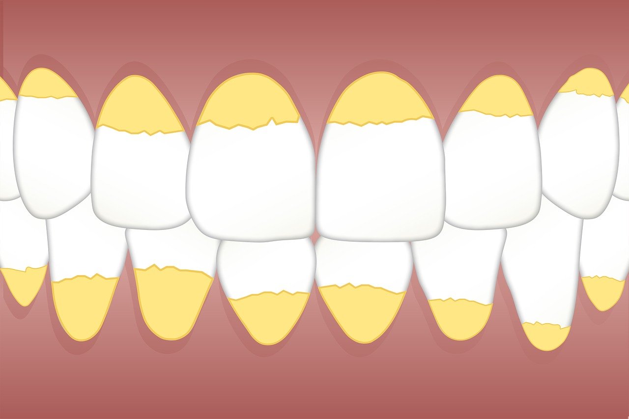 ¿Cómo se quita el cálculo de los dientes?