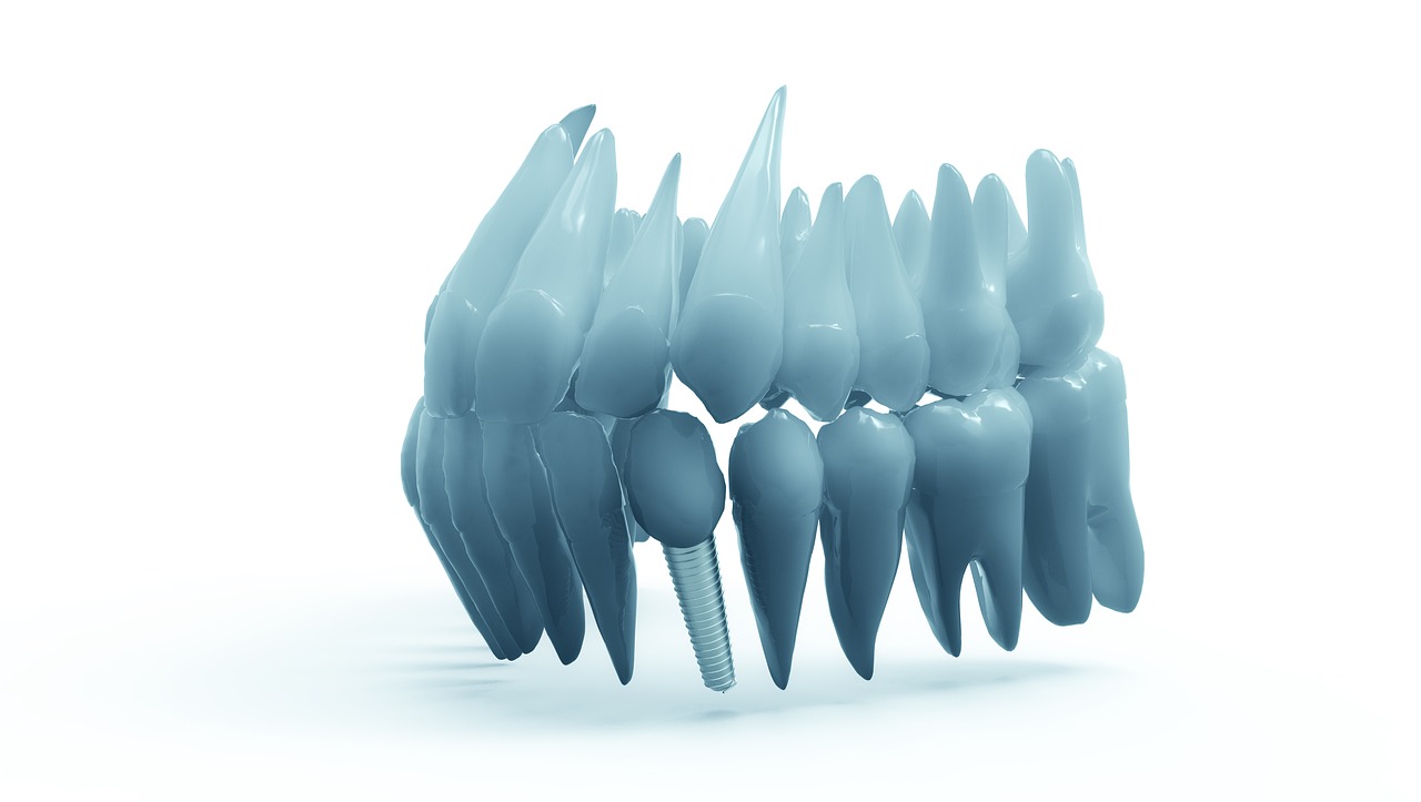 ¿Qué significa implantes de carga inmediata?