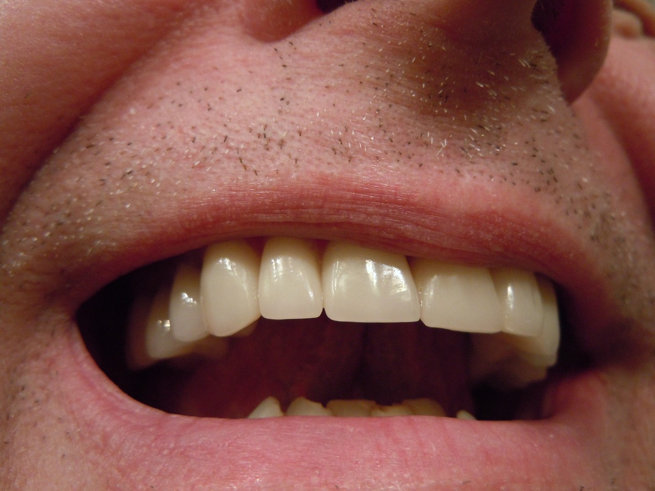 ¿Cuando está indicada una corona dental?