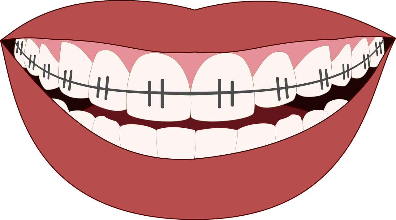¿Cómo se llaman los aparatos que van en los dientes?