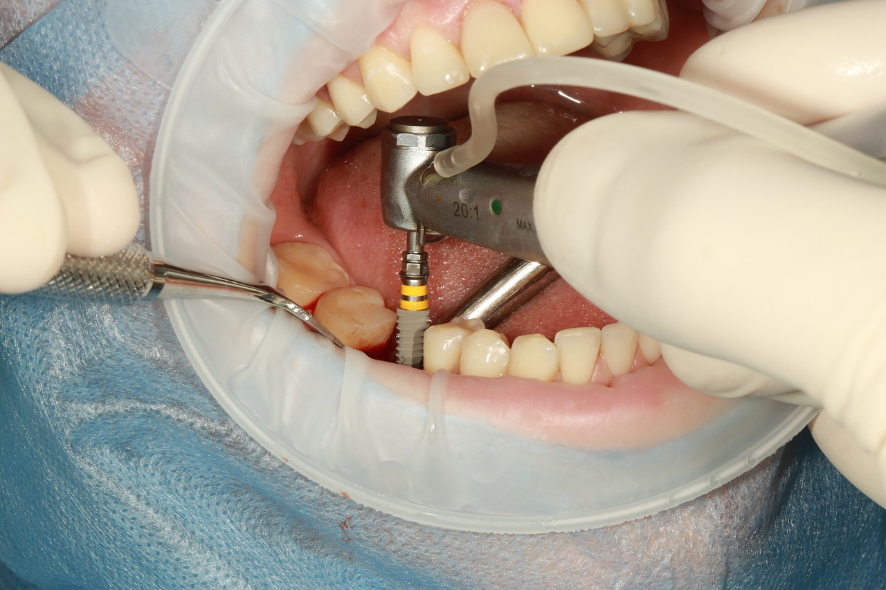 ¿Qué tipo de implantes utiliza dentix?