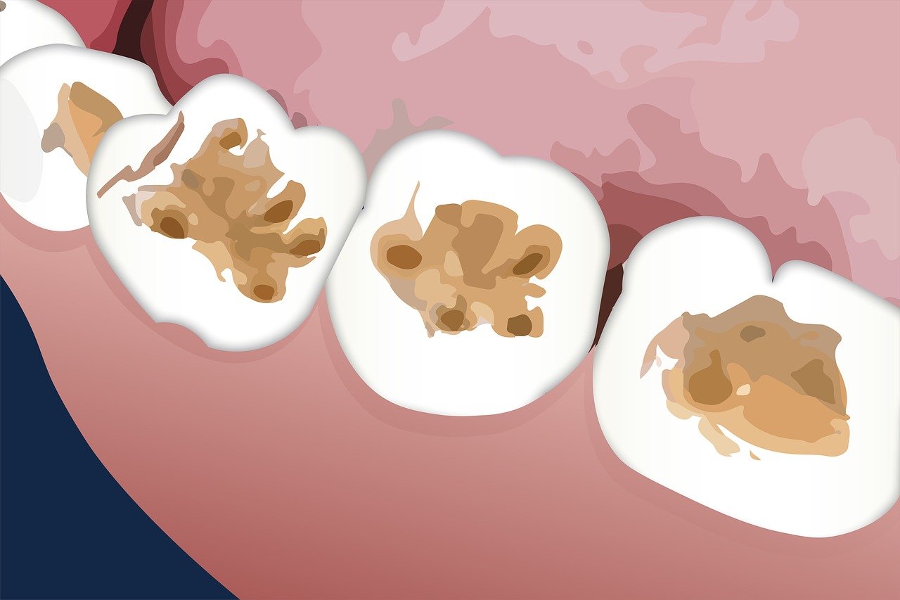 ¿Qué hacer para recuperar el esmalte de los dientes?