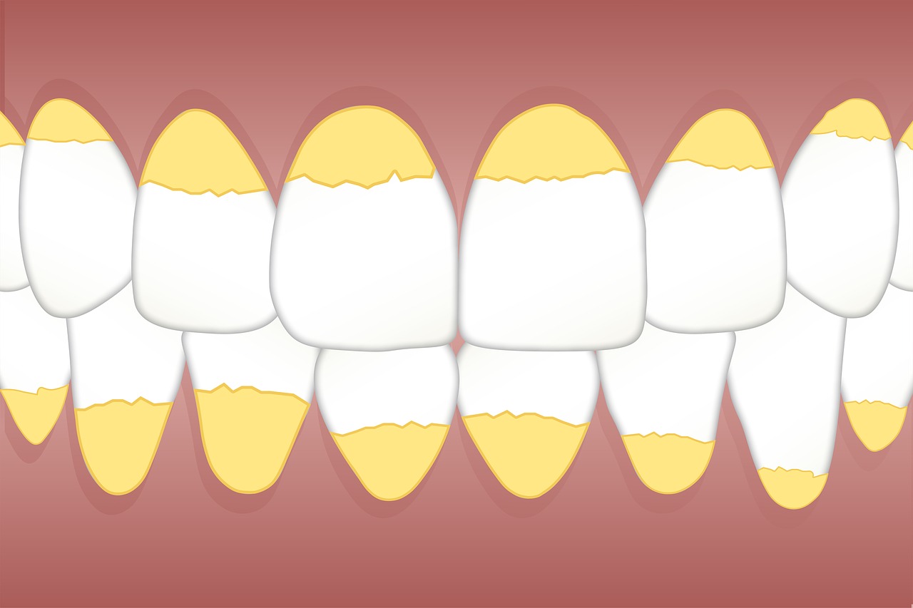 ¿Qué es el cálculo dental o sarro?