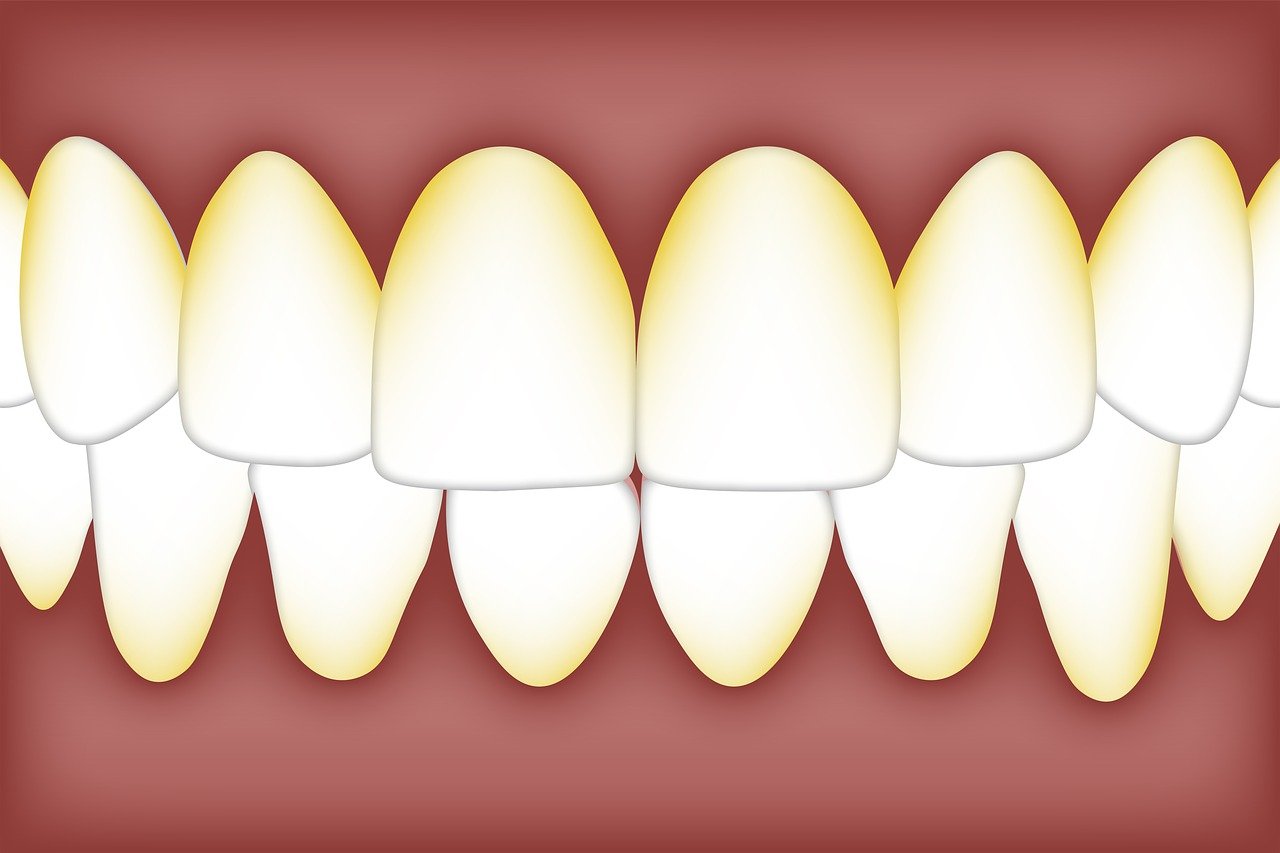 ¿Cómo se llama la enfermedad de los dientes con sarro?