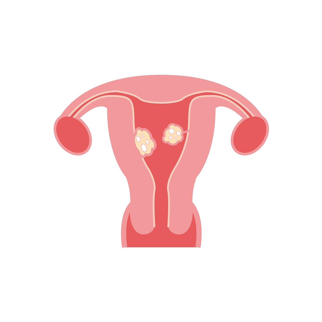 ¿Cómo saber si es un fibroma?