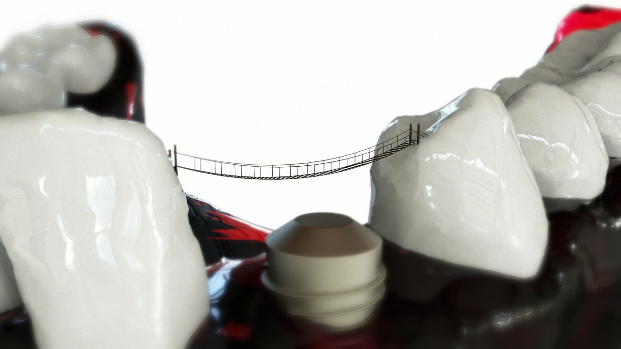 ¿Qué es una prótesis hibrida sobre implantes?