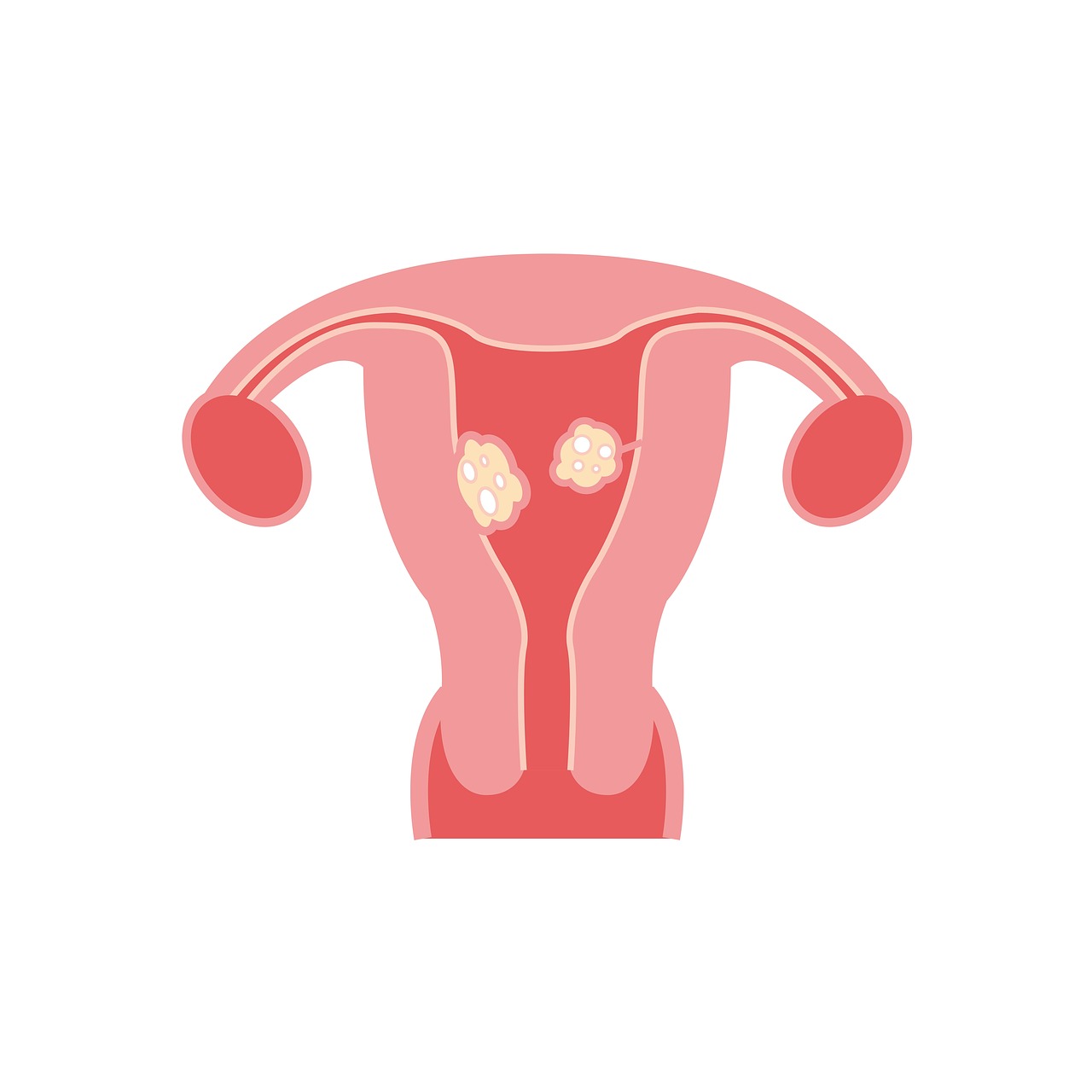 ¿Cómo quitar un fibroma en la mejilla?