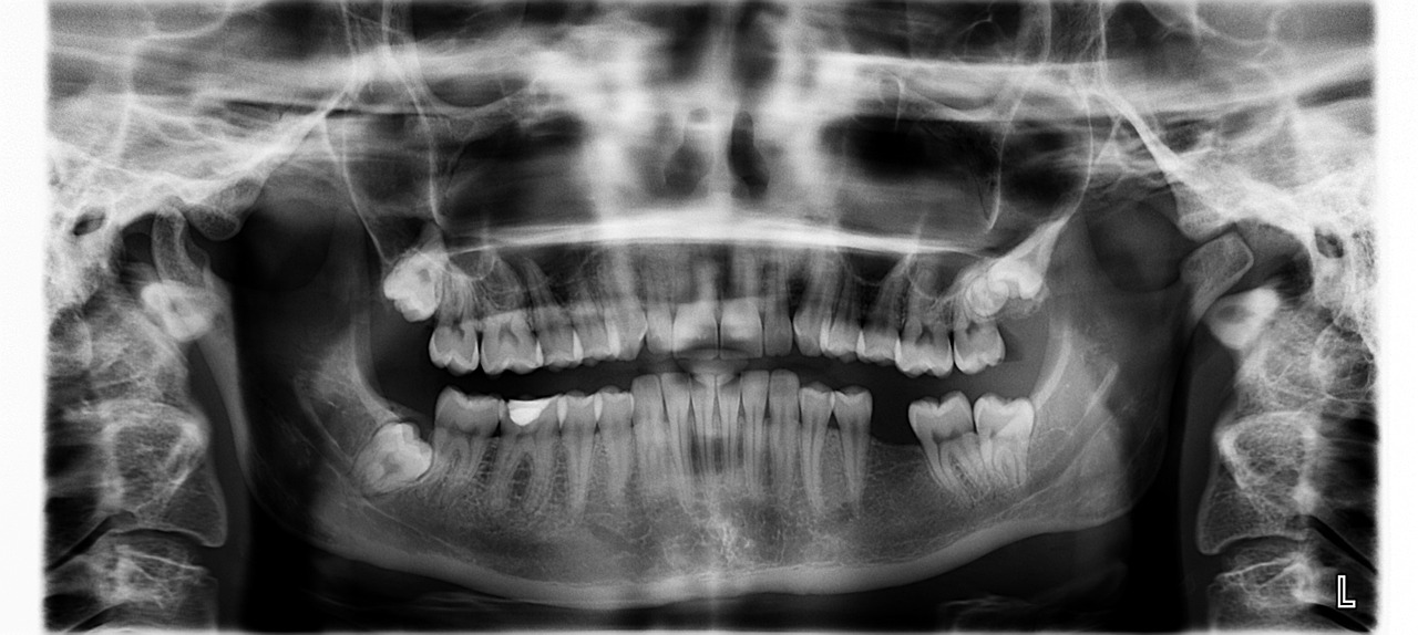 ¿Cómo se llama la radiografía que se hace en la boca?