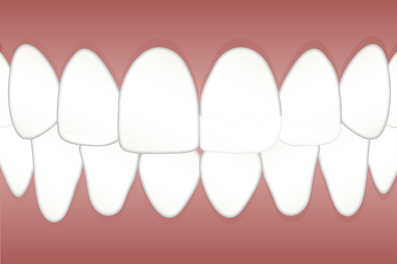 Can fluorosis be removed from teeth?