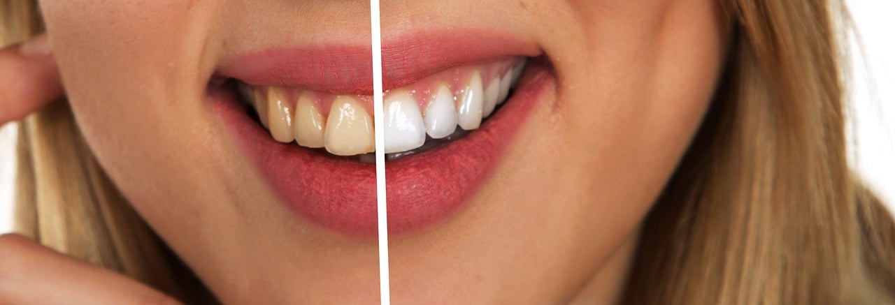 ¿Qué es la cresta en odontología?