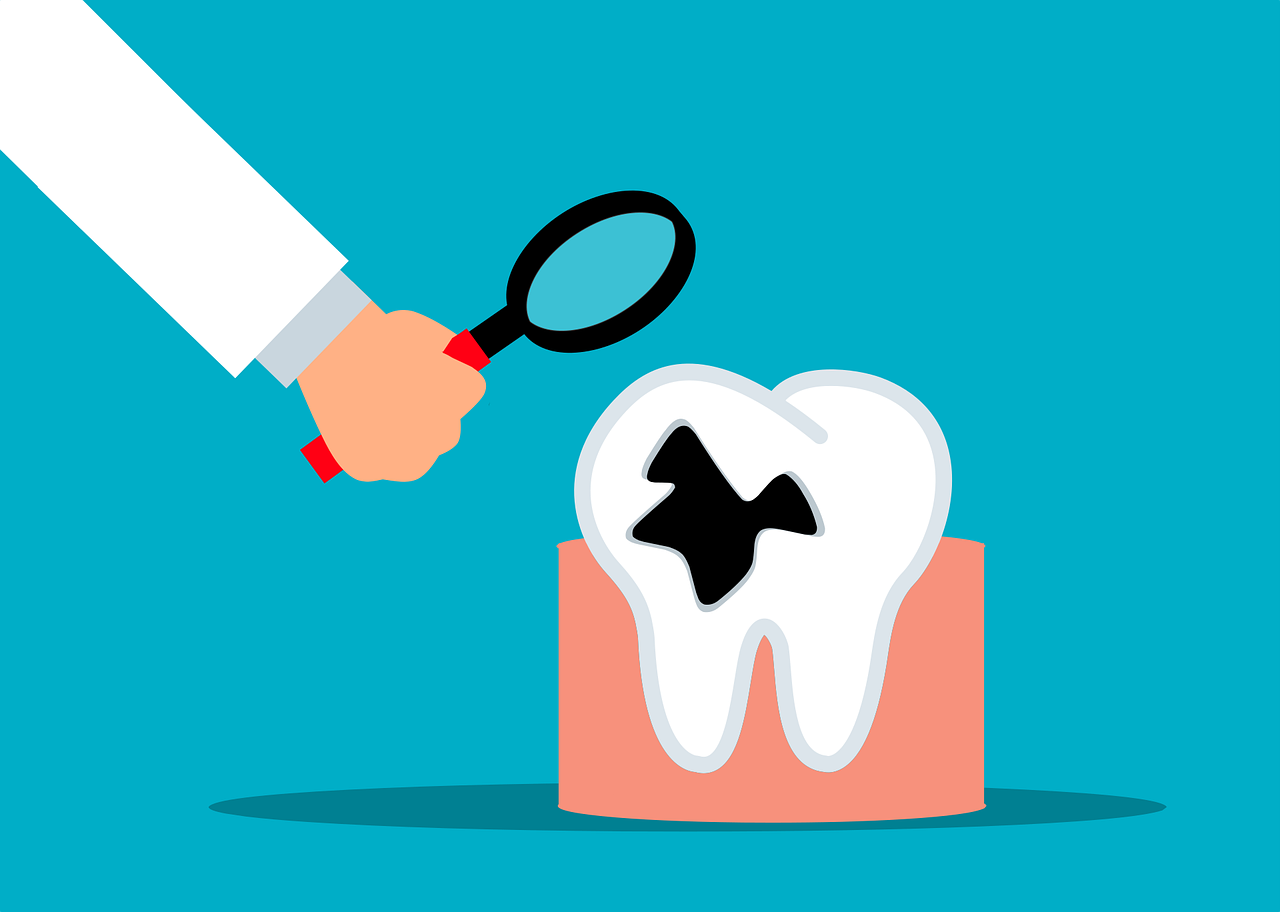 ¿Cómo se transmite la caries dental?