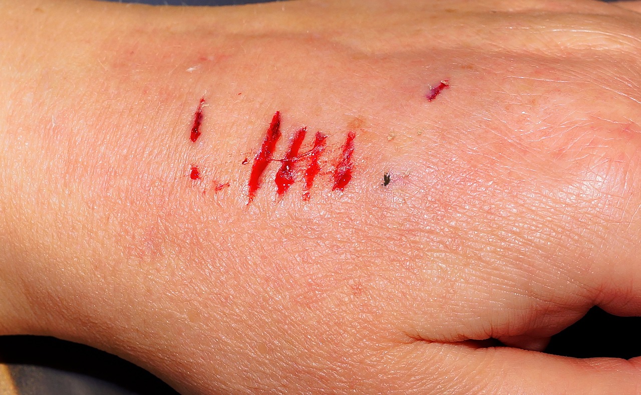 ¿Cómo se clasifican las mordeduras de perro?