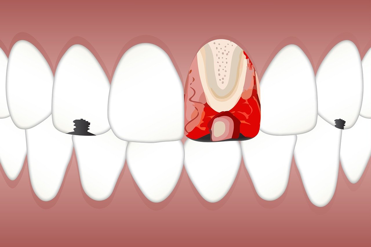 ¿Qué es la pulpitis crónica?
