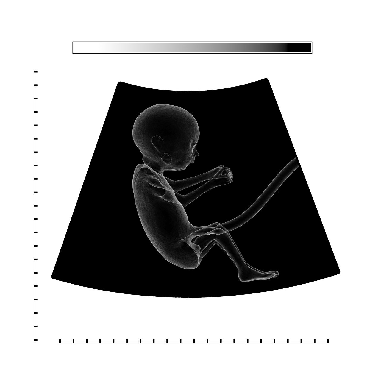 ¿Qué es la limpieza bucal con ultrasonidos?