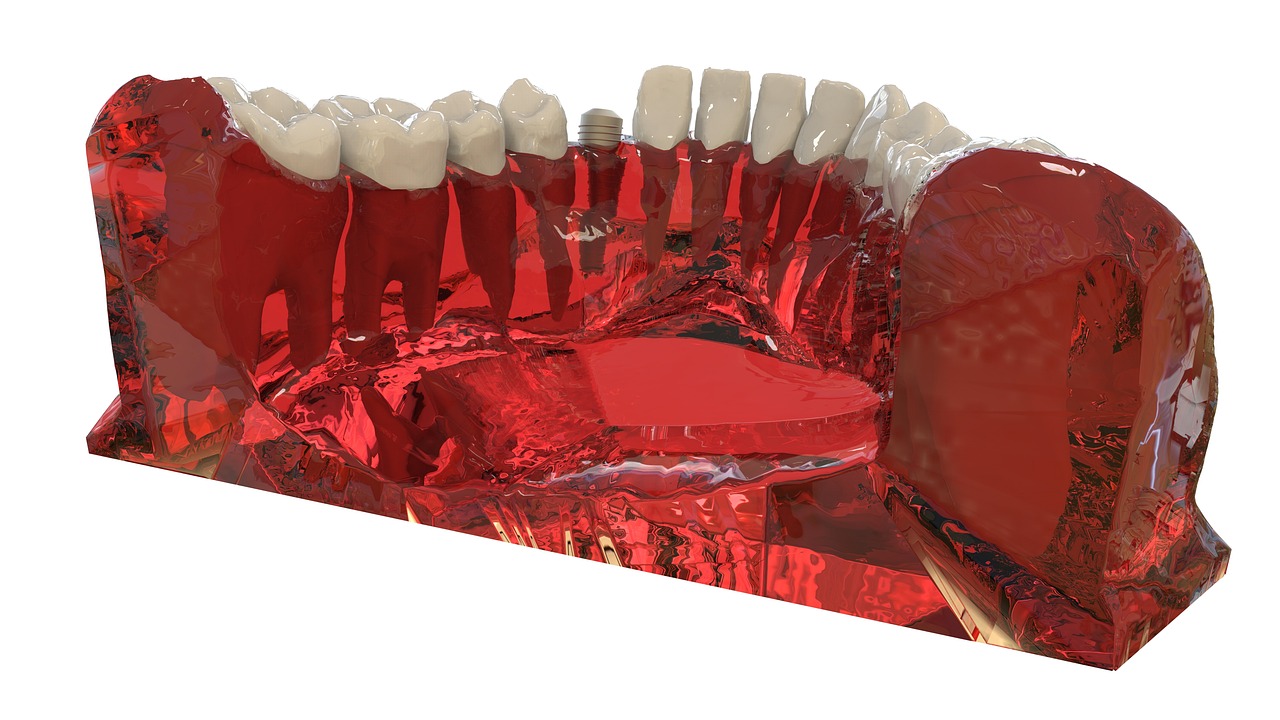 ¿Qué marca de implantes utiliza Dentix?