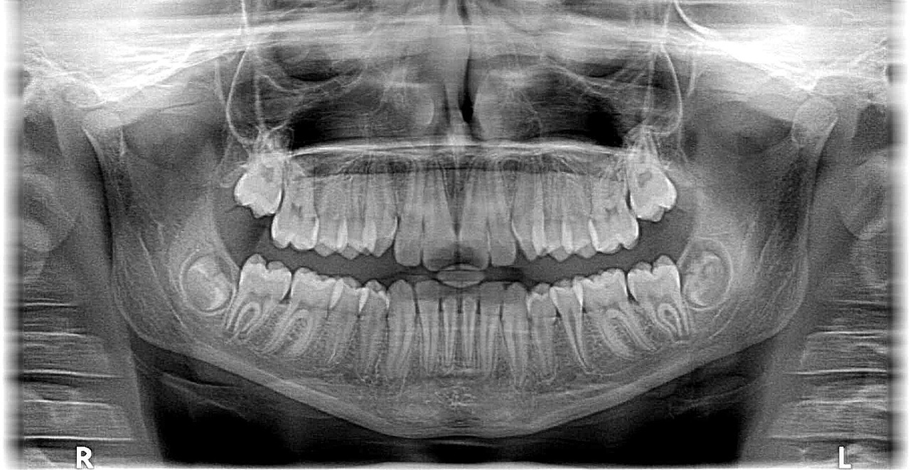 ¿Cuando te ponen brackets puedes fumar?