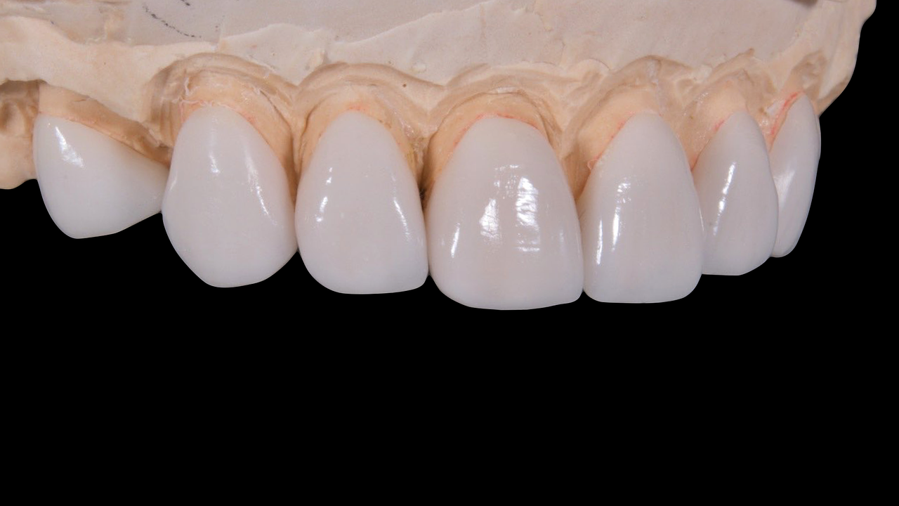 ¿Cómo se usa la cera dental?