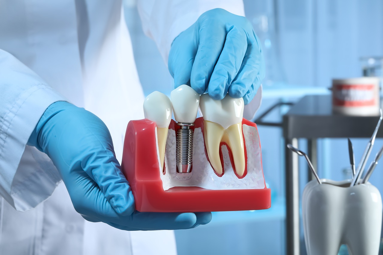 ¿Qué problemas puede tener un implante dental?