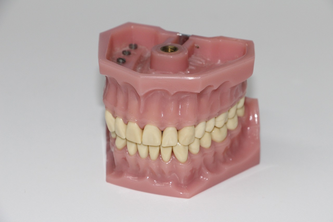 ¿Qué es mejor puente o prótesis dental?