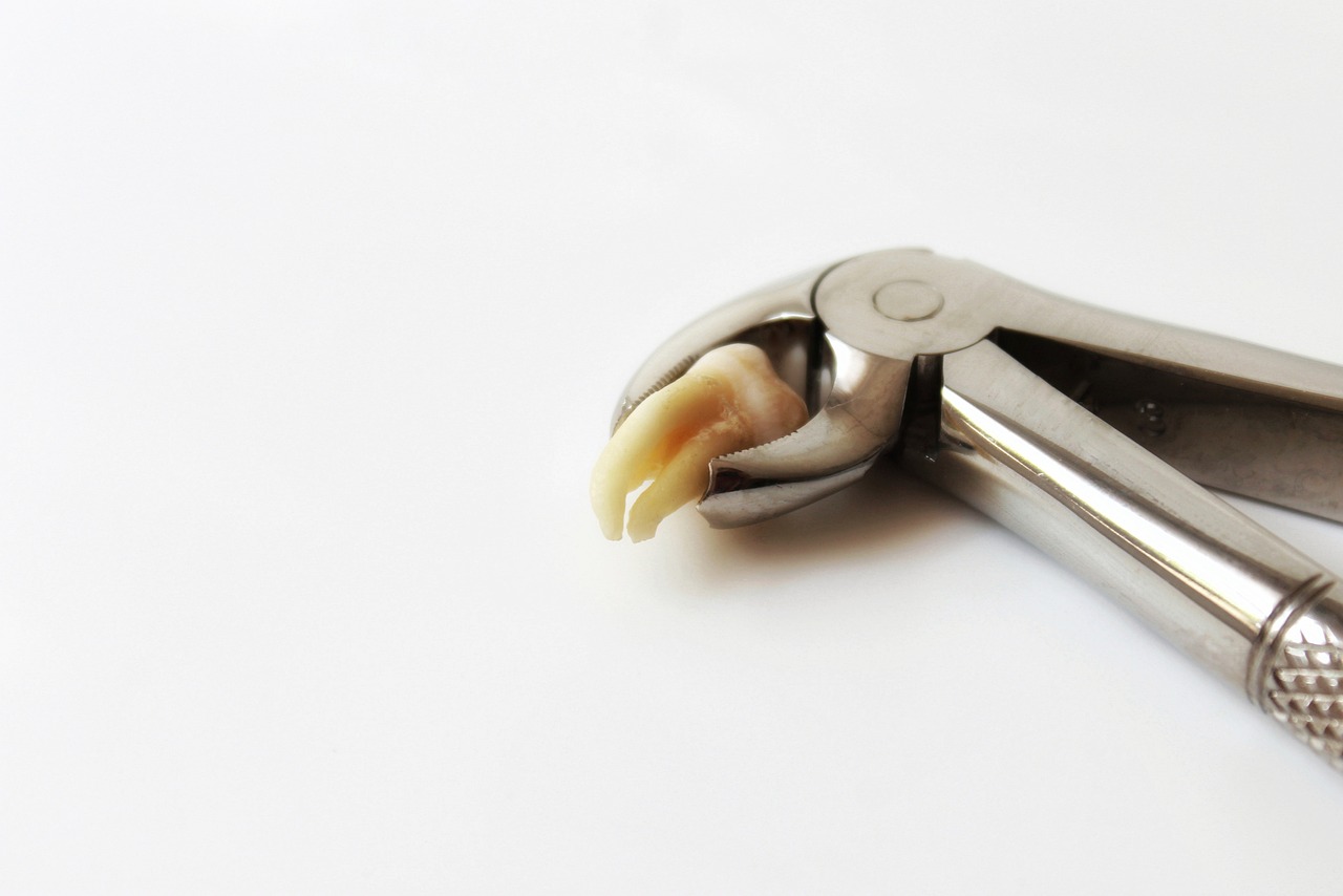 ¿Qué duele más una extracción de muela o una endodoncia?
