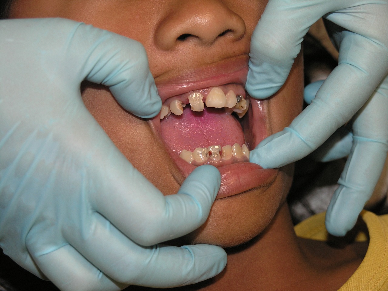 ¿Cómo calmar el dolor de un diente con caries?