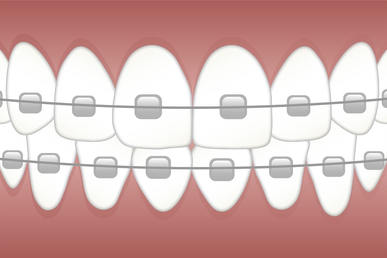 ¿Cómo quedan los dientes después del tratamiento de ortodoncia?