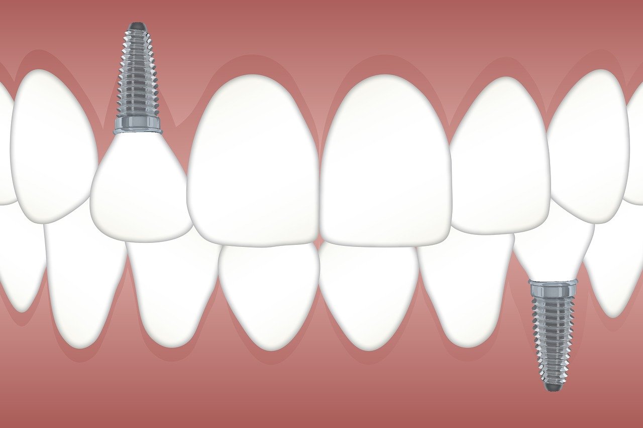 How long do metal teeth implants last?